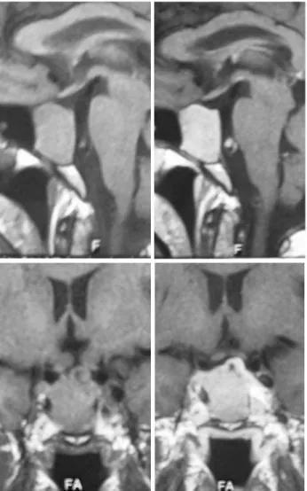 Figura 1. Ressonância magnética pré-tratamento com bromocriptina (imagens pré e pós-contraste).