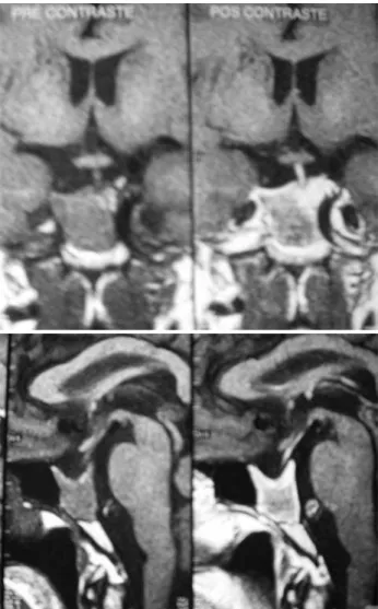 Figura 2. Ressonância magnética pós-tratamento com bromocriptina (imagens pré e pós-contraste).