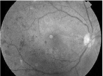 Figura 1. Paciente do sexo feminino, 49 anos, DM há 7 anos e visão de 20/20 (100%). Retinografia do 1° exame mostra hemorragias do tipo  dot and blot nos 4 quadrantes e  irregu-laridade da parede venosa, classificando-a como retinopatia diabética não proli