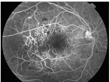 Figura 2. Paciente do sexo masculino, 30 anos, DM há 20 anos e visão de 20/20 (100%). Retinografia do 1° exame mostra hemorragias retinianas, manchas algodonosas, raros exsudatos duros e neovasos de papila