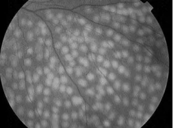 Figura 4. Panfotocoagulação retiniana com laser de argônio (marcas recentes). Nota-se que toda retina isquêmica é  foto-coagulada, não apenas o local dos neovasos.