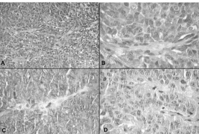 Figura 5. Ressonância magnética de sela túrcica em corte coronal, ponderado em T1, mostrando volumosa massa intra e supra-selar condicionando infra-desnivelamento do  assoa-lho selar e envolvendo a artéria carótida interna direita.