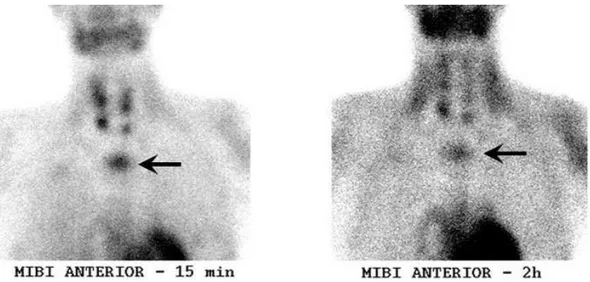 Figura 1. Cintilografia das paratireóides realizada em dois tempos (15 minutos e 2 horas) após a administração de sestamibi-