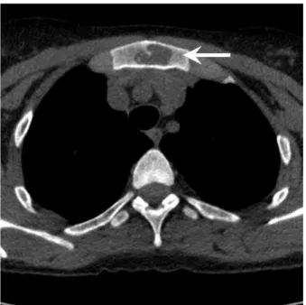 Figura 3. Tomografia computadorizada de tórax mostrando lesão lítica no esterno.