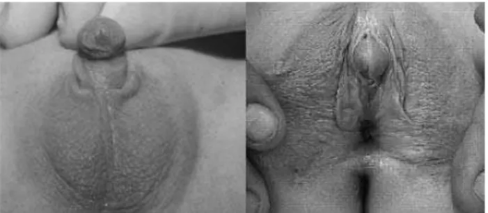 Figura 2. Representação fotográfica da genitália no pré-operatório (Prader V) e 10 anos após a genitoplastia feminizante.