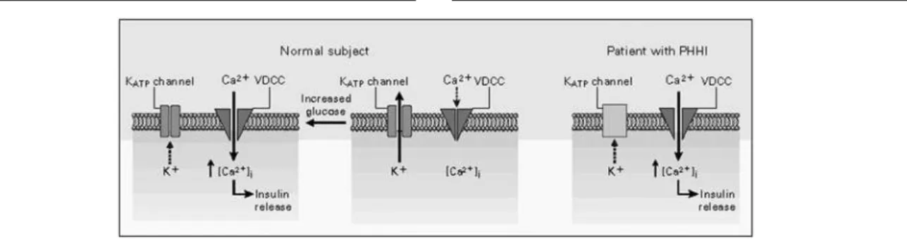 Figura 3. Esquema demonstrando o K ATP canal em célula beta pancreática normal e com Hipoglicemia Hiperinsulinêmica Persistente da Infância (PHHI).