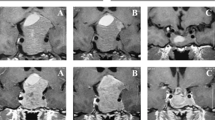 Figura 1. Ressonância magnética ponderada em T1, sem (imagens superiores) e com contraste (imagens inferiores) de paciente do sexo masculino de 29 anos, portador de macroprolactinoma, com perda visual progressiva há 2 anos, sem diagnóstico prévio.