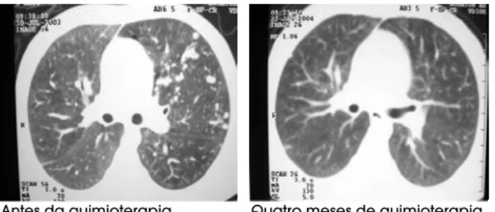Figura 2. Tomografia axial computadorizada de tórax mostrando remissão completa de metástases  pulmo-nares de TCA por quimioterapia com etoposídeo, doxorrubicina, cisplatina e mitotano, em uma menina de 5 anos de idade.