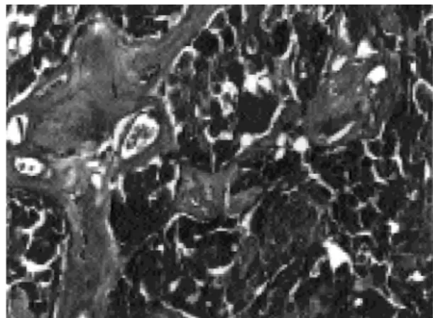 Figura 2.  Fotomicrografia revelando imunorreatividade citoplasmática para calcitonina nas células tumorais  (téc-nica da avidina-biotina-peroxidase, 200x).