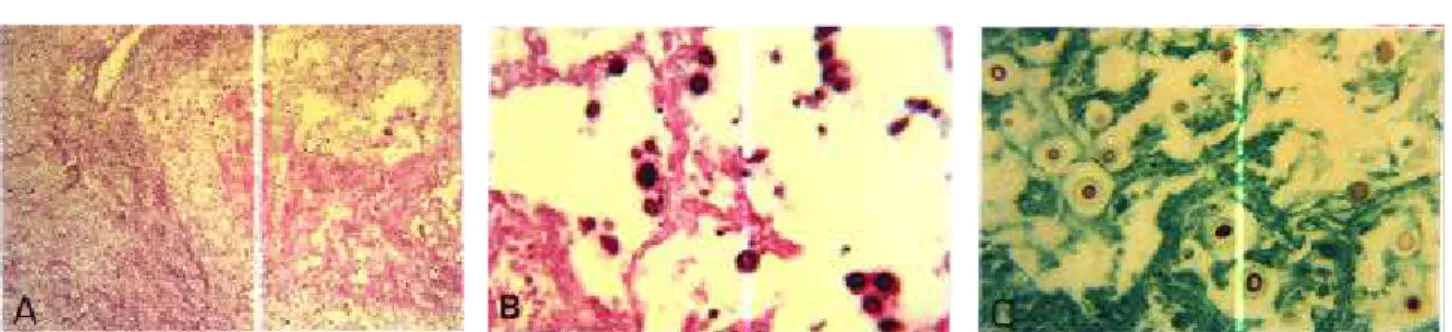 Figura 4. A: panorâmica do nódulo pulmonar mostrando, à direita, faixa de fibrose e, ao centro, áreas de necrose, com Cryptococcus neoformans em meio a lacunas de material mixóide (PAS