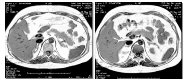 Figura 2. RM de abdômen (T1 fora de fase, sem supressão de gordura) de paciente com com- com-plexo de Carney: aspecto micronodular da adrenal esquerda.