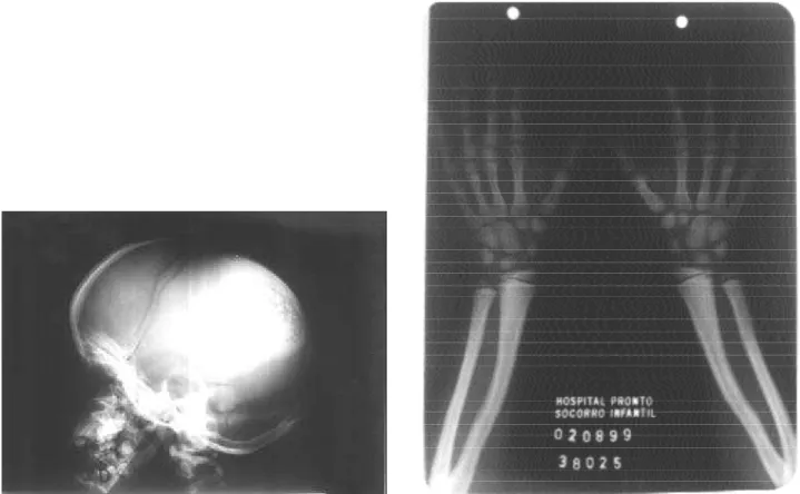 Figura 2. Caso 1:  A - Radiografia do crânio em perfil.  B - Radiografia de mãos e punhos.