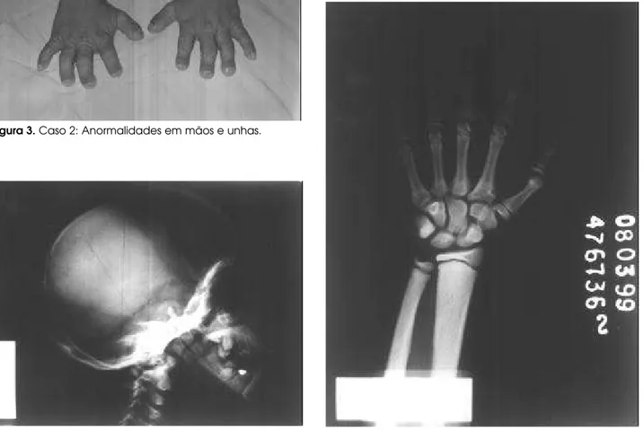 Figura 4. Caso 2:  A - Radiografia do crânio em perfil.  B - Radiografia de mão e punho esquerdos.
