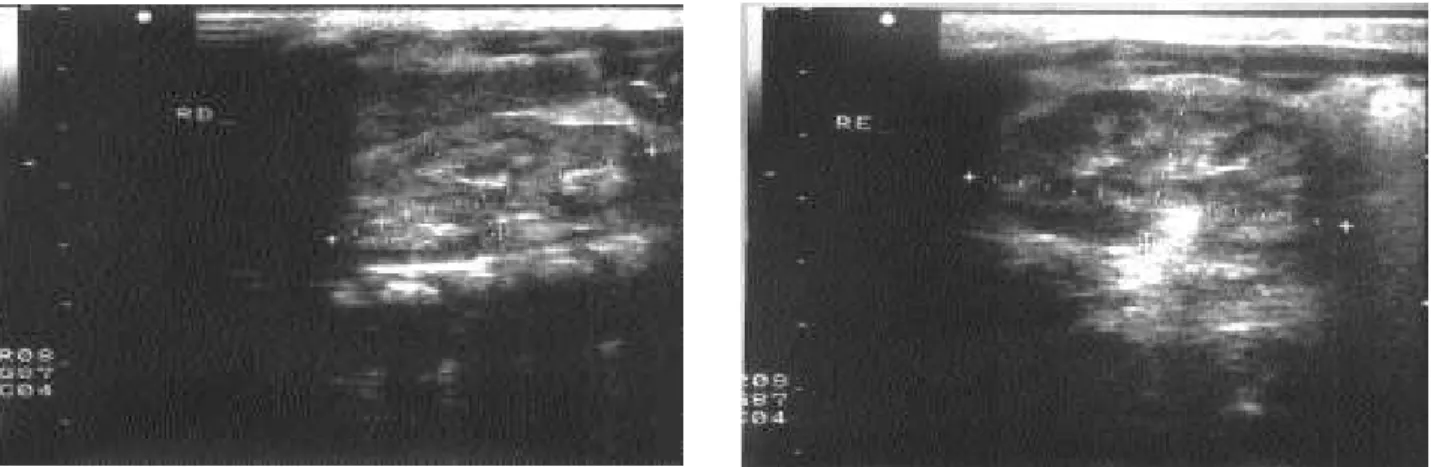 Figura 1. Ultrassonografia de rim D e E mostrando a presença de calcificações nas pirâmides renais e litíases.