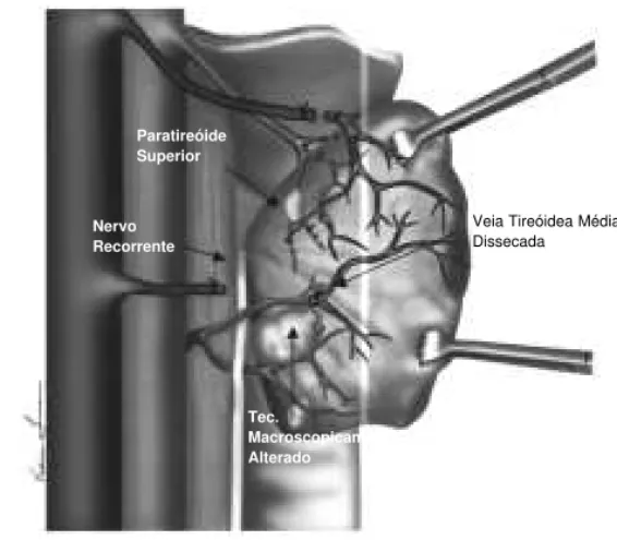 Figura 1: Tecido macroscopicamente normal posterior a veia tireóidea média - sem manipulação das estruturas  posterior-mente ao plano de secção, portanto, ressecção parcial