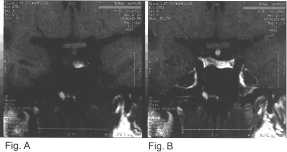 Figura 1. Ressonância magnética: hipófise de dimensões normais e haste discretamente espessada (A: T1 sem contraste e B: T1 com contraste).