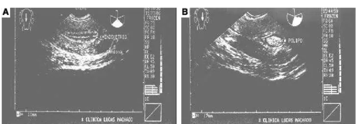 Figura 2. Paciente com sangramento uterino anormal, sob reposição hormonal. A: Ultra-sonografia mostrando apenas um mioma intramural