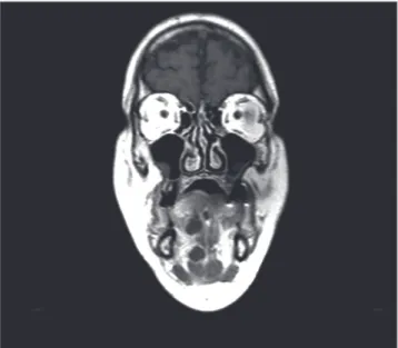 Figura 4. Corte Axial T1 sem contraste.