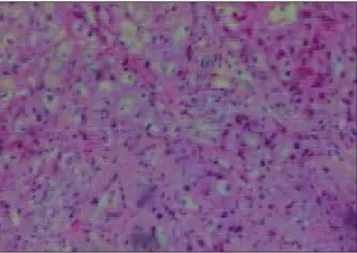 Figura 3.  Exame de microscopia óptica do carcinoma mucoepidermoide de glândulas salivares menores.