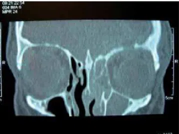 Figura 2. Tomografia computadorizada dos seios paranasais (corte coronal com janela para parte óssea) com áreas com densidade de partes moles em seio esfeinodal esquerdo e parcialmente à direita.