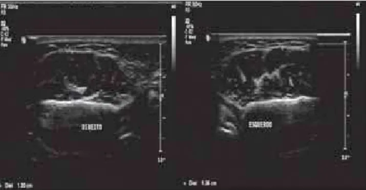 Figura 2. Imagem ultrassonográfica dos músculos masseteres direito e esquerdo no repouso.