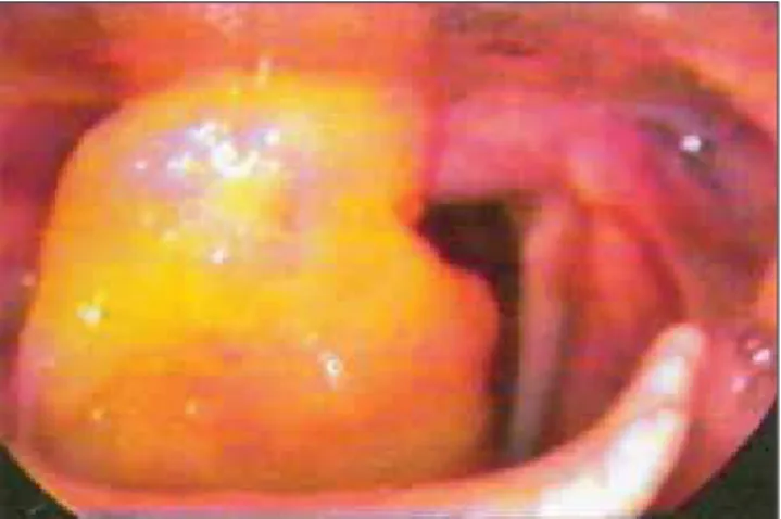 Figura 1. Telelaringoscopia aonde pode ser observada lesão localizada na região supra-glótica (prega ariepiglótica e prega vestibular) do lado direito e com obstrução de  aproximada-mente 60-70% do ádito laríngeo.
