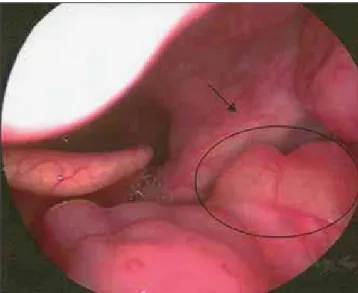 Figura 4. Telelaringoscopia aonde pode ser observada lesão residual anterior, ressecada no último procedimento.