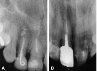 FIGURA 2 - Radiografia periapical de dente submetido ao tratamento clareador em 1990 e radiografado em 1996 sem suspeita de reabsorção cervical.