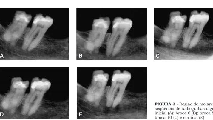 FIGURA 3 - Região de molares – seqüência de radiografias digitais: