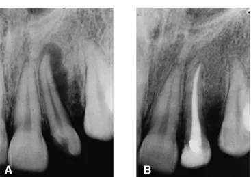 FIGURA 1 - A: radiografia de odontometria do dente 12, apresentando extenso processo osteolítico periapical