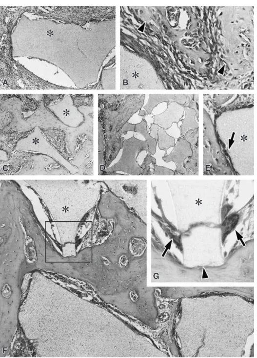 FIGURA 1 - Flocos da resina de mamona ( \ ) circundados por tecido de granulação, com a presença de trabéculas osteóides nas proximidades de sua