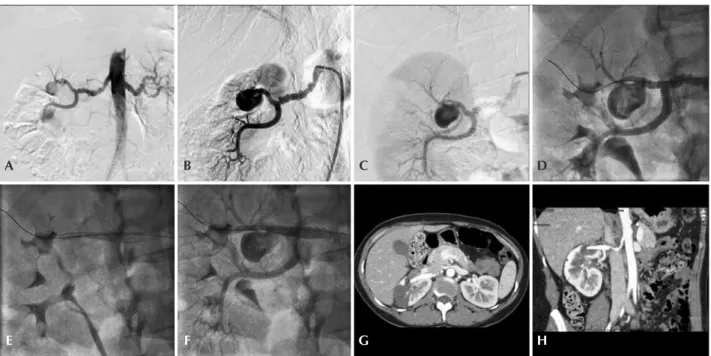 Figura 6. Tratamento do aneurisma de artéria renal do tipo II com uso de endoprótese Multilayer ® 