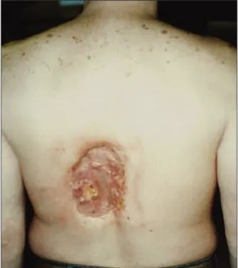 Figura 2. Lesão na pele em homem de 40 anos submetido a múltiplas  coronariografias. Aproximadamente 18 a 21 meses depois do pro  ce-dimento, evidencia-se necrose dos tecidos