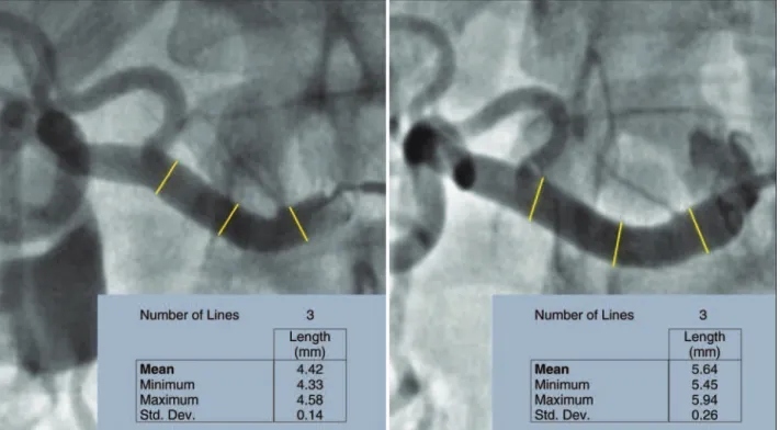 Figura 4.  Mudança  nos  diâmetros  máximos  das  artérias  renais  aos  6  meses  após  denervação  simpática  renal  (DSR)  percutânea.