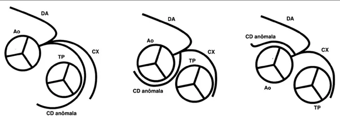 Figura 2. Representação esquemática dos trajetos de coronária direita anômala. 4  À esquerda, artéria coronária direita anômala que se origina da  artéria descendente anterior, dirige­se anteriormente ao tronco pulmonar, antes de alcançar o sulco atriovent