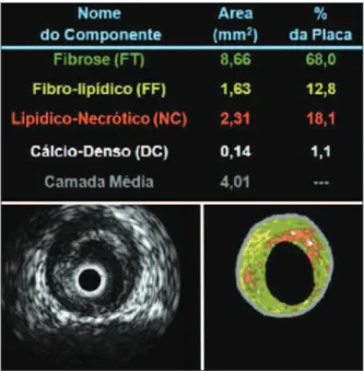 Figura 2 - Imagens obtidas por meio de ultrassom intracoronário em  escala de cinza (à esquerda) e Histologia Virtual ®  (à direita)