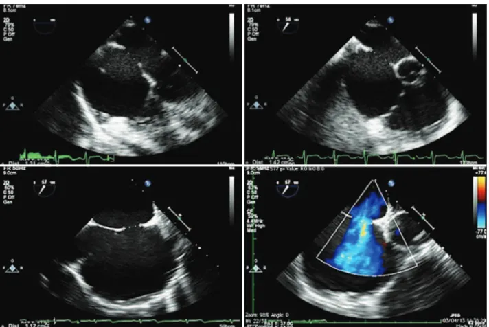 Figura 2 – Avaliação ecocardiográfica bidimensional da comunicação interatrial, evidenciando seu aspecto favorável para o tratamento percutâneo