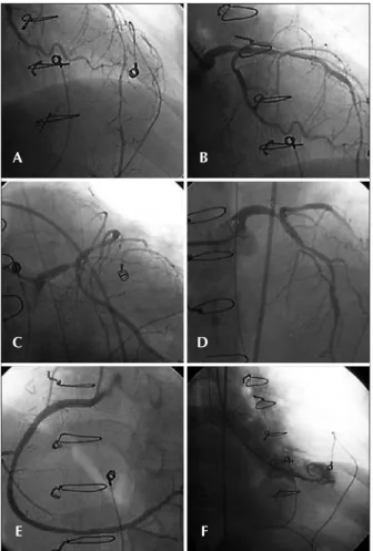 Figura 1 - Em A, B, C e D, coronária esquerda em projeções oblíqua  anterior esquerda, oblíqua anterior direita caudal, oblíqua anterior  esquerda caudal e oblíqua anterior esquerda cranial, respectivamente