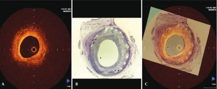Figura 2. Cortes transversais de artéria coronária suína com stent farmacológico. (A) Tomografia de coerência óptica; (B) histologia; (C) imagens  sobrepostas, com a finalidade de escolher seção transversa da tomografia de coerência óptica análoga à imagem