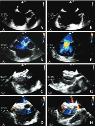 Figura 3. Comunicação interatrial sem bordo aórtico. (A) Ecocardiograma  no eixo curto