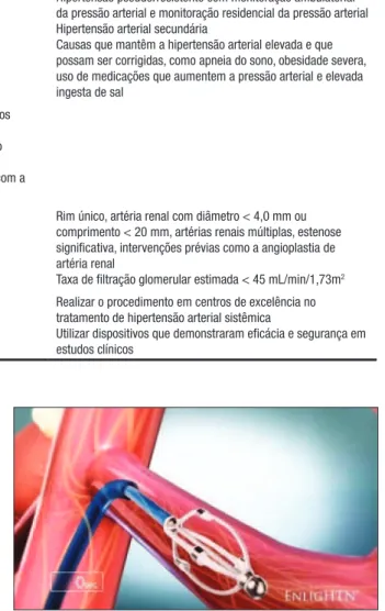 Figura 3. EnligHTN ®  Renal Denervation System.