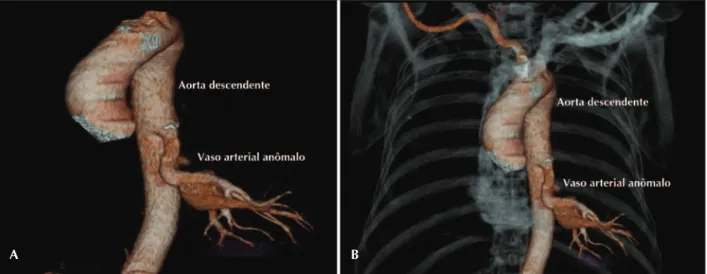 Figura 1  ­  Angiotomografia  computadorizada  do  tórax.  Em  A  e  B,  presença  de  vaso  arterial  anômalo  que  emerge  da  aorta  descendente  em  direção  ao lobo pulmonar inferior, à esquerda