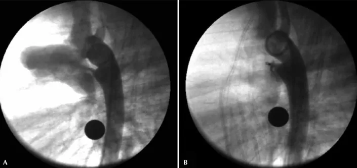 Figura 2 - Canal arterial tipo A com 2 mm de diâmetro na extremidade pulmonar, em que foi utilizado dispositivo Amplatzer ®  Vascular Plug II de 4 mm  com sucesso