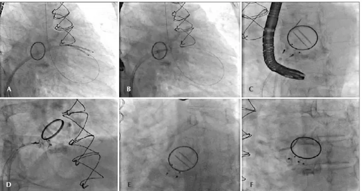 Figura 1 - Em A, cateteres no ventrículo esquerdo após ultrapassarem o orifício paravalvar mitral