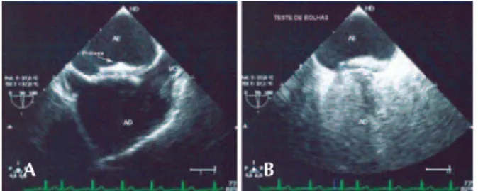 Figura 5 - Detalhes do ecocardiograma transesofágico de controle, 6  meses após o implante