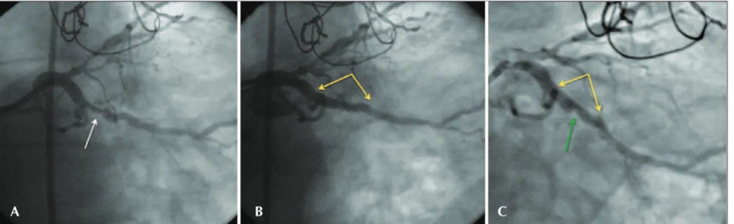 Figura 1 – Cineangiocoronariografia do procedimento e aos 6 meses. Em A, angiografia revelando lesão excêntrica no terço médio da artéria cir- cir-cunflexa