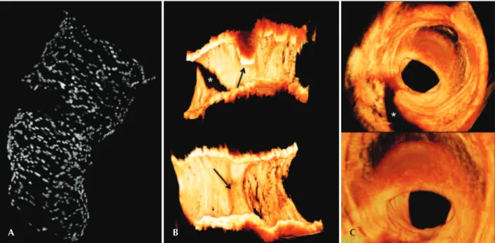 Figura 3 – Reconstrução tridimensional das imagens de tomografia de coerência óptica. Em A, reconstrução tridimensional do stent, revelando des- des-continuidade da estrutura do stent no local da reestenose, por importante atenuação do sinal óptico promovi
