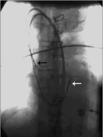 Figura 3 - Posicionamento dos cateteres diagnósticos em átrio direito  (seta preta) e região do feixe de His (seta branca).
