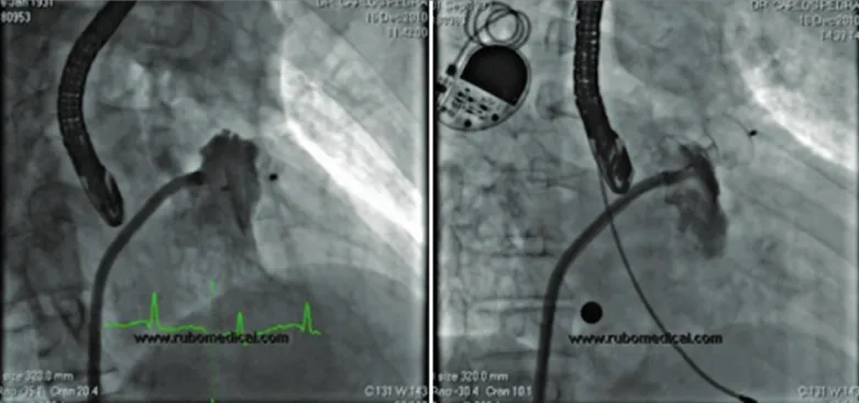 Figura 10 - Angiografias pelo braço lateral da bainha longa. À esquerda, aspecto do dispositivo do paciente 2 após liberação final do cabo, em que se observa discreta protrusão da porção superior do disco de vedação proximal para dentro do apêndice, em dec