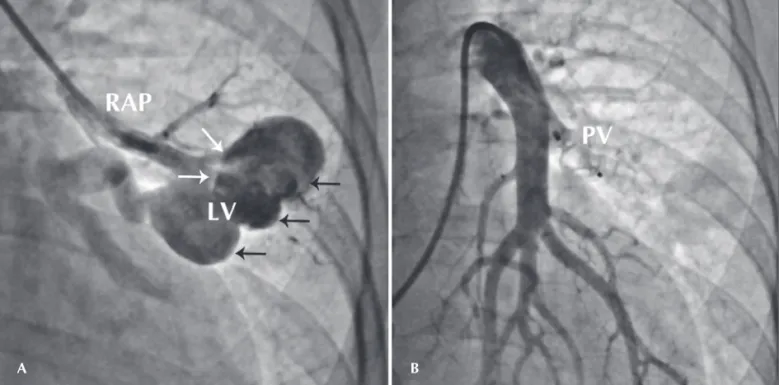 Figura 2 - Em A, bifurcação (setas brancas) do ramo arterial pulmonar (RAP), dando origem à fístula arteriovenosa pulmonar com formação de grande lago venoso (LV) trilobulado (setas pretas)
